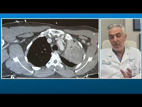Surgeon explains what Pope Leo's lung cancer diagnosis means