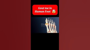 Gout toe in Human Foot | Anatomy 🔥 | 3D animation