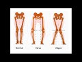 Varus and Valgus Stress to the Knee - YouTube