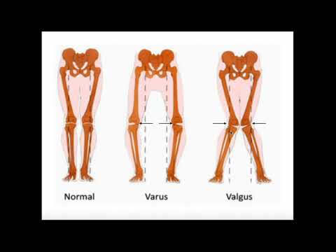 Βίντεο: Προκαλεί το coxa vara το γόνο valgum;