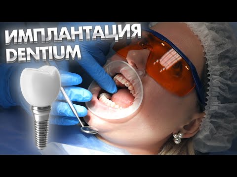 Классическа имплантация седьмого зуба по хирургическому цифровому шаблону