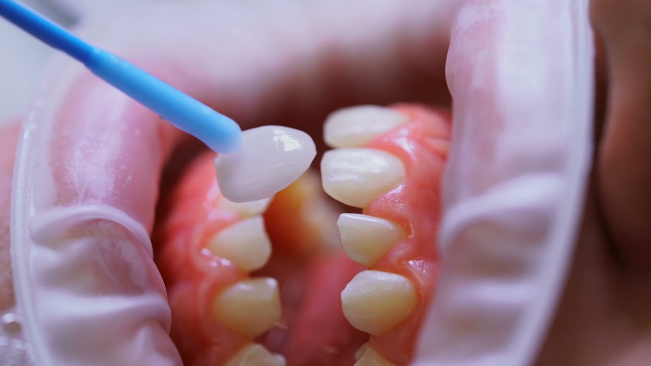 Smile Design . Non Prep Veneers . Gum Correction.Veneers Zähne