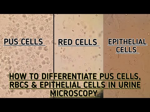 Pus cells,Red blood cells & Epithelial cells seen in urine microscopy.How to differentiate between.