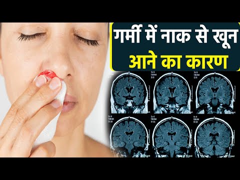 वीडियो: गर्मियों में नाक से खून क्यों आता है?