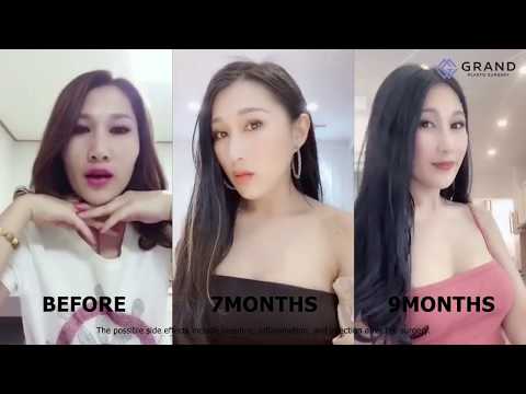 Phẫu thuật hạ