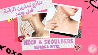 NECK/SHOULDERS Exercises Results Before and After pics | نتائج تمارين الرقبة والكتف صور قبل وبعد