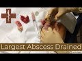 Largest Abscess I've EVER drained - YT sanctioned version