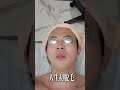 @BIOチャンネル 朝倉未来さんプロデュースのBIO MENSクリニックで初脱毛!