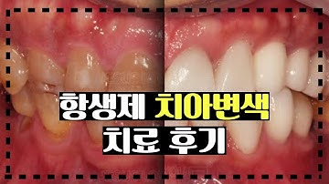 항생제로 인한 선천적 치아변색 스트레스도 하루만에 탈출! 一天解决四环素牙、先天性牙齿变色