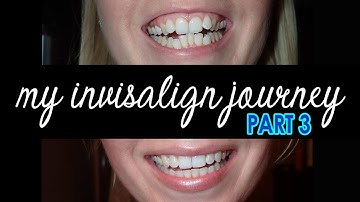 My Invisalign Journey PART 3 | Finishing Up The Invisalign Process + Results + Vivera Retainers!