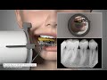 Dexis titanium by kavo  full mouth series positioning guide