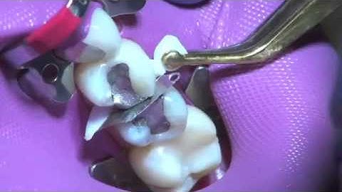 Class II Restorations- Abrading Adjacent Teeth | Dentsply Sirona
