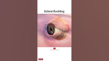 Scleral buckling | animation video