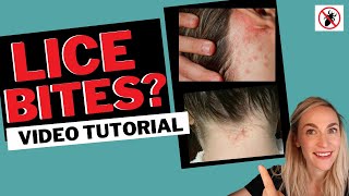 Lice Bites Tutorial