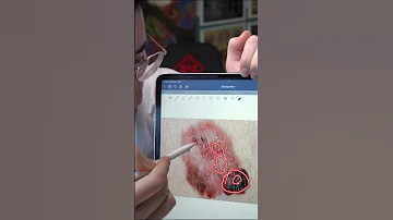 ميلانوم أو شامة حميدة ما هو الفرق بين الشامة العادية والميلانوما سرطان الجلد طب اكسبلور ترند 