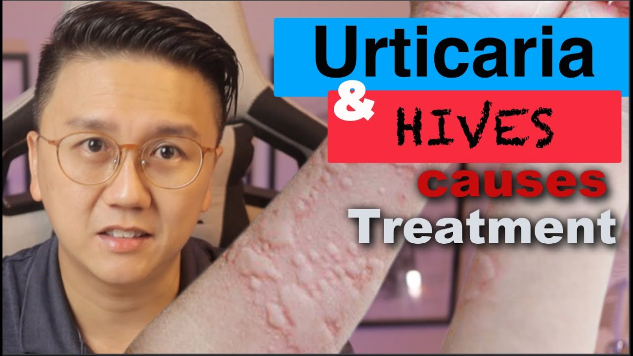 Urticaria And Hives Causes And Treatment Of Itchy Skin Rash Youtube