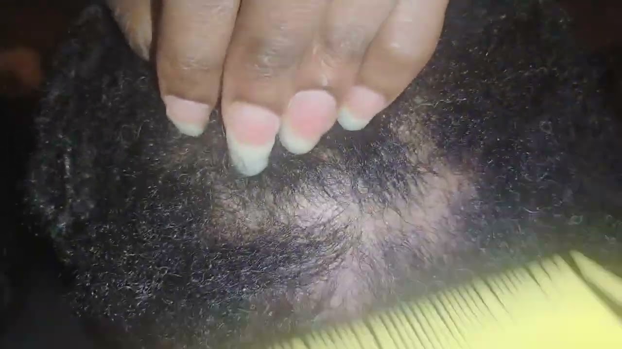 Dandruff scratching #scratch 