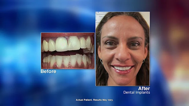 Replacing Missing Teeth with Dental Implants with ...