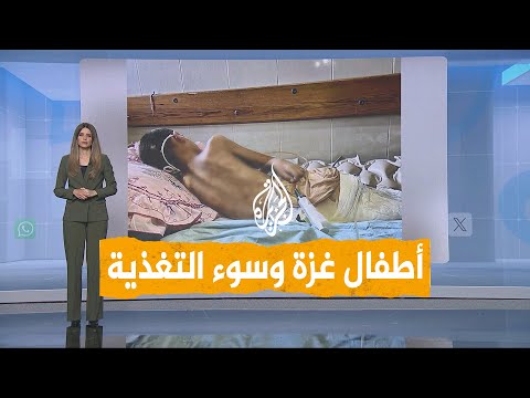 شبكات |  أطفال غزة يواجهون خطر سوء التغذية