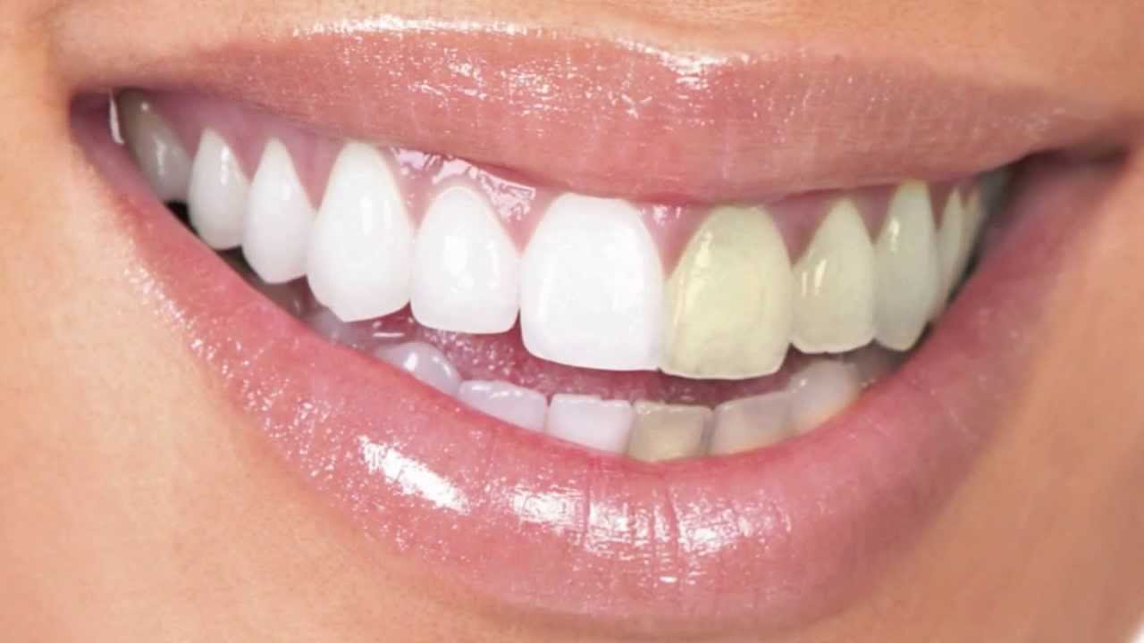 Precio Blanqueamiento Dental - YouTube