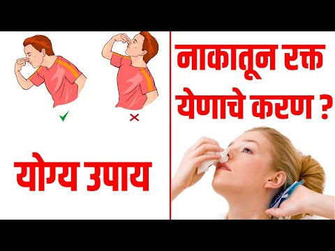 नाकातून रक्त आल्यास काय होऊ शकते?  Nose Bleeding मोठा आजार! Best Home Treatment on Nose Bleeding