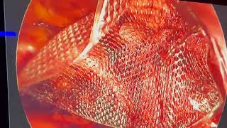 tep hernia repair dr ben