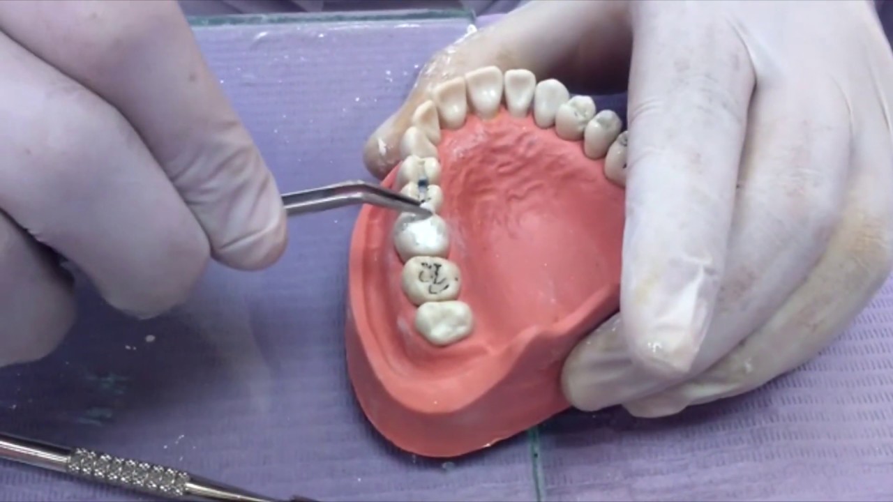 Cementos Dentales : Oxido de Cinc y Eugenol