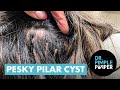 Small &amp; Pesky Pilar Cyst on Scalp