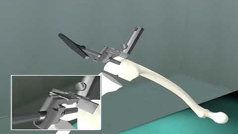 buechel pappas total knee replacement surgery animation video -orthobiologicsdoc