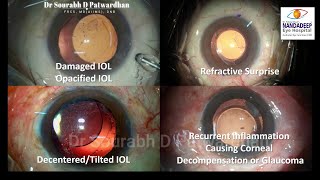 155 IOL explantation tricks..presented in a conference Dr Sourabh Patwardhan