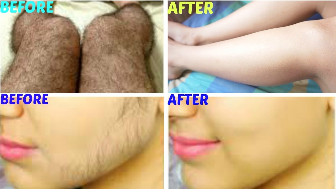 Remove Body And Facial Hair At Home Get Rid Of Facial Hair