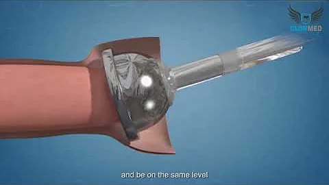 Circumcision Staplers from CLONMED Explained