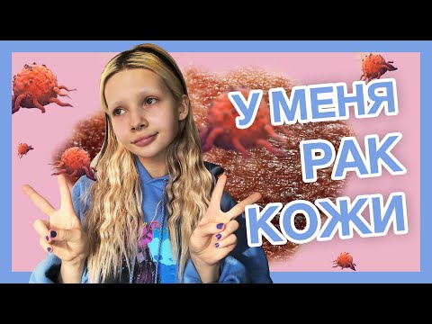 МОЯ РАКовая ИСТОРИЯ | МЕЛАНОМА