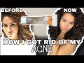 How I Got Rid Of My Acne | #HOWTOGETRIDOFACNE #HOWTOGETRIDOFACNESCARS