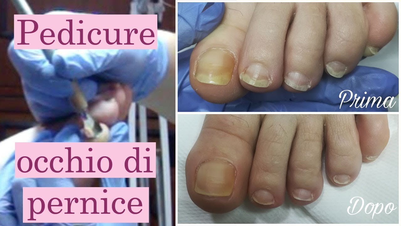 Estetica tutorial Pedicure con rimozione occhio di pernice e consigli per la cura dei piedi a Estetica tutorial Pedicure con rimozione occhio di pernice e consigli per la cura dei piedi a