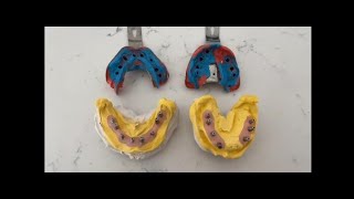 Kapalı Ölçü Yöntemi ile İmplant Üzeri Ölçü Alımı