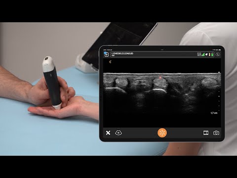 Image of Pulleys of the Flexor Tendons