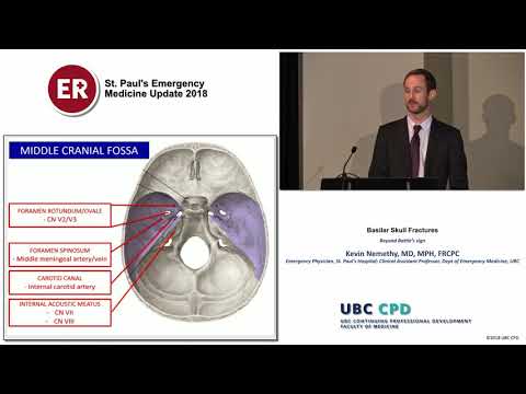 Basilar Skull Fractures (St Paul&rsquo;s EM Update 2018)