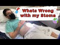 Prolapsed Stoma Issues😱 - One Piece Bag System