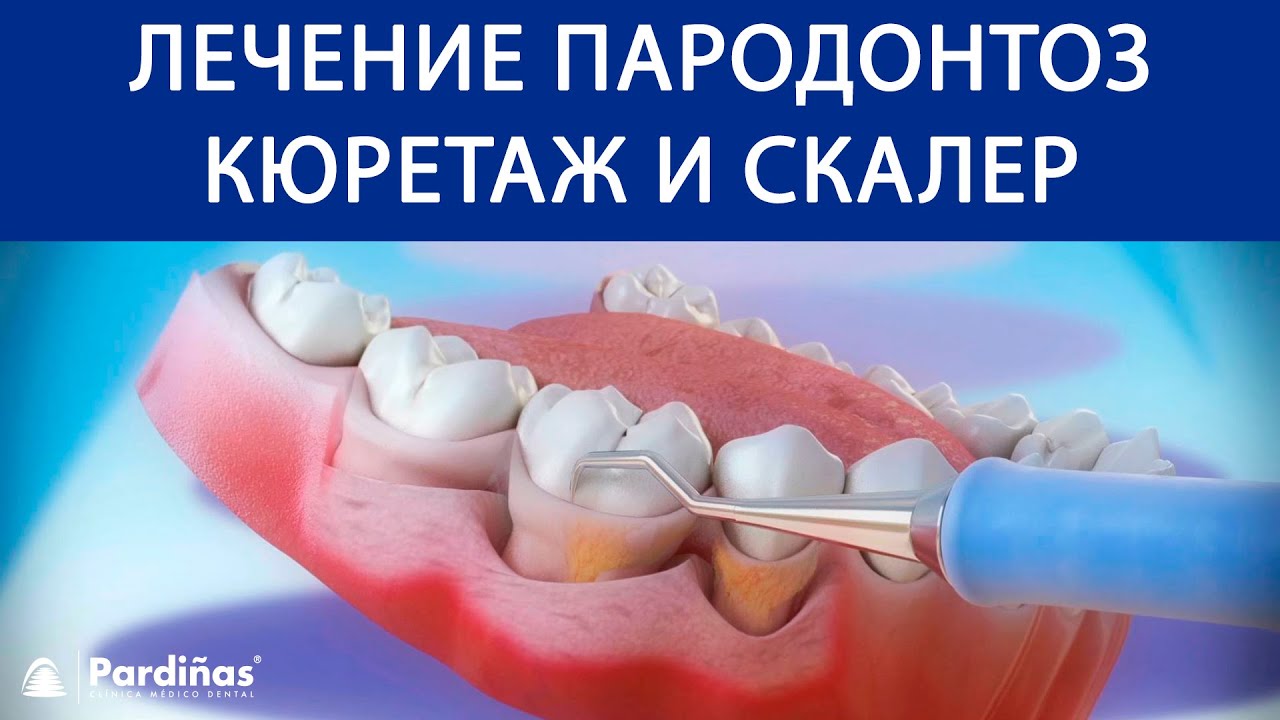 лечение пародонтоза стоматология