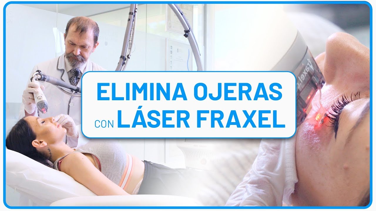Tratamiento Para Quitar Las Ojeras 👀 Cómo quitar las OJERAS en solo 5 minutos con LÁSER [TRATAMIENTO