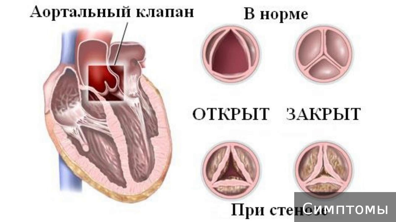 Аортальный стеноз что это такое