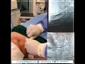 تحجيم للأنزلاق الغضروفي في الرقبة بواسطة إبرة الليزر بدون جراحة