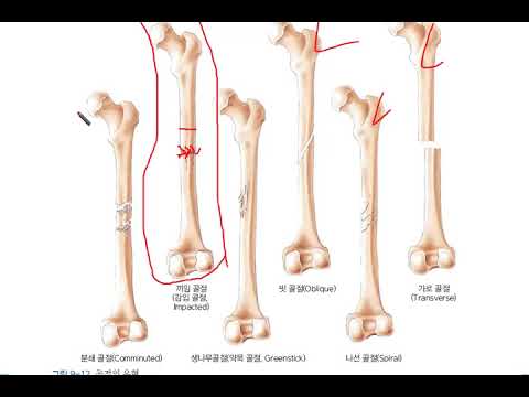 골절 유형에는 무엇이 있지?? 소아는 성장판이 있고 연골이 있는데 성인과 동일한 골절이 일어날까?? #응급구조사 #전문외상처치학 #PHTLS #ACLS