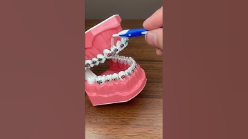 Hướng dẫn vệ sinh răng niềng bằng bàn chải kẽ  #niengrang #orthodontist #niềngrăng #dentist