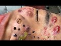 Blackhead Removal With Sac Dep Spa @10006897