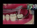 Class II Fillings - Tips & Tricks