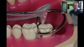 Class II Fillings - Tips \& Tricks