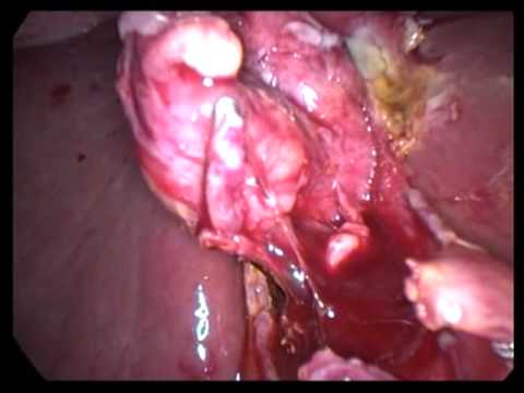 Laparoscopic Cholecystectomy (unedited-23)-In Acute Cholecystitis With Perforation In GB Difficult C