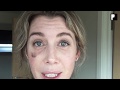 Blepharoplasty Video Diary - 3 Weeks After Surgery (13 of 15)